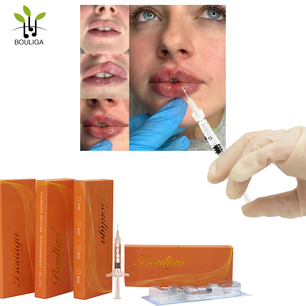 Relleno dérmico de ácido hialurónico superior Bouliga 5 ml Relleno de labios mejorado no quirúrgico
